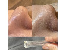 毛穴に溜まった皮脂汚れを専用液でゴッソリ吸引ツヤ肌へ6000円◎