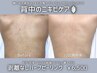 〈驚異の殺菌力!背中ニキビケア〉2回目以降も同価格◎選べる上部 or 下部