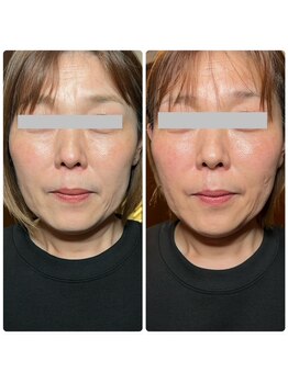 エルブラン(Herb ame)/お顔脂肪分解(お顔10分)