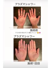 キワミ サーティスリー(kiwami33)/手が荒れてお悩みの方お試しを