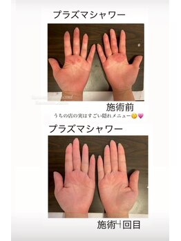 キワミ サーティスリー(kiwami33)/手が荒れてお悩みの方お試しを