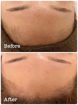 ミラ(Mila)/毛穴洗浄&お顔脱毛1回施術後