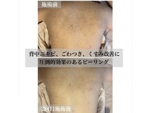 サンテ パシャ(Sante Pasha)の雰囲気（圧倒的効果の背中ピーリング◎施術症例写真はInstagramより☆）