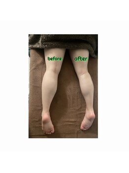 エムラナ(M lana)/before after