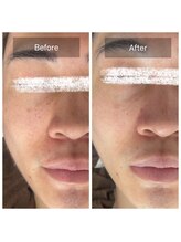 ラビ(RABBI)/20代男性メンズピーリング