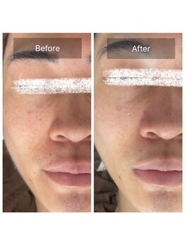 ラビ(RABBI)/20代男性メンズピーリング