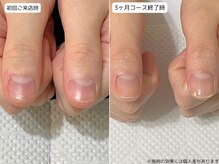 カピリナ(Ka Pilina)/自爪育成・川崎・深爪