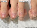 自爪育成・川崎・深爪
