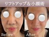 【小顔/たるみ改善】サーモシェイプDeep（顔全体20分）＋カウンセリング30分