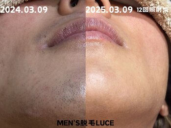 ルーチェ/【ヒゲ脱毛】若々しいお肌に