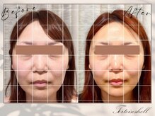 トーティシェル(tortoise shell)/中顔面短縮もお任せください