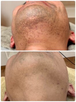 ティアレ 廿日市店(Tiare)/髭脱毛　ひげ　爆抜けモード