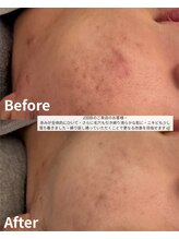 ニコ(nico)/繰り返す大人ニキビ・肌荒れに。