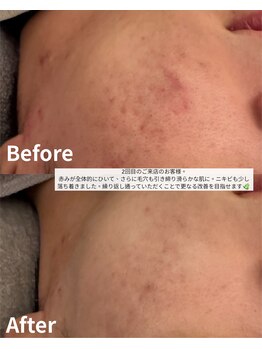 ニコ(nico)/繰り返す大人ニキビ・肌荒れに。