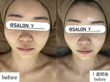 サロンワイアネシス(Salon y ANESIS)/ハーブピーリング×コルギ　