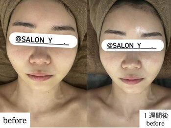 サロンワイアネシス(Salon y ANESIS)/ハーブピーリング×コルギ　