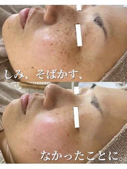 セリー(Celie)の写真/年齢を重ねた肌に本気のシミケア。絶対変われる自信あります。内側から変える肌管理サロン