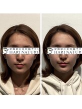 ハリナチュレ 神戸元町店/小顔美容鍼初回体験 BeforeAfter