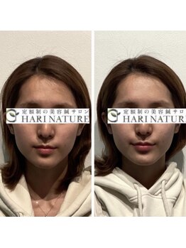 ハリナチュレ 神戸元町店/小顔美容鍼初回体験 BeforeAfter