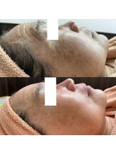 リッツ 大宮店/【Before/After】肌質改善