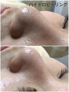 サロンドフルール/ハイドロピーリング