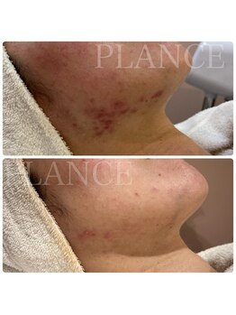 プランス 恵比寿店(PLANCE)/頑固なフェイスラインのお悩み