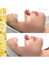 リアム(LiAm)/脂肪分解剤《レモンボトル》