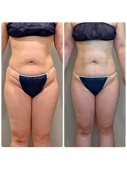 エクセレントビューティーサロン 艶(EN)/減量プログラム　7ｋｇ減量