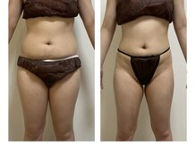 ホズリル(Hozril)/当店人気の痩身エステ☆