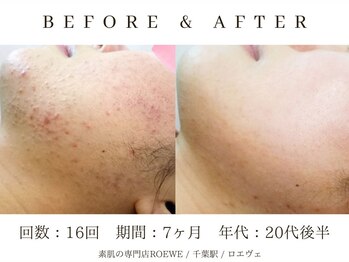ロエヴェ(ROEWE)/ニキビ改善・毛穴ケア・肌質改善