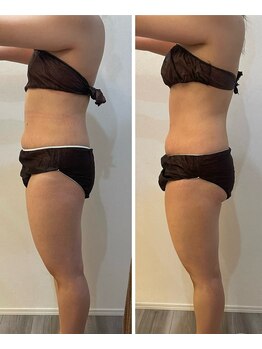 モゼ(moze)/ウルトラ痩身90分