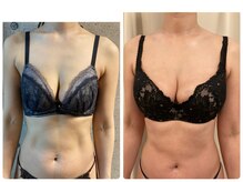 ハイファイブ(Hi-Five)/バストアップ/施術10回