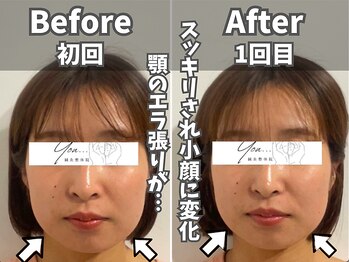 鍼灸整体院ユー(鍼灸整体院You...)/美容鍼×小顔矯正　施術後の変化