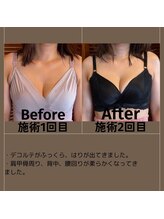 エミニナル(EMININAL)/【バストケア】ビフォーアフター