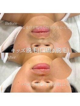 ナナイロサロン ニコリー(NaNairo nicolly)/【キッズ脱毛口周り】