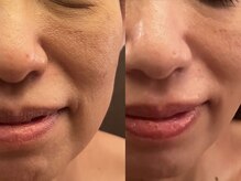 エステ ラミ(Esthe' l'ami)/たるみケア毛穴＋小顔