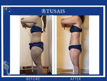 ビテュセ(美Tu sais)/【痩身・ダイエット】ボディケア