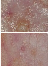 ゼロプラス(ZERO+)/【フェイシャル】効果実感！