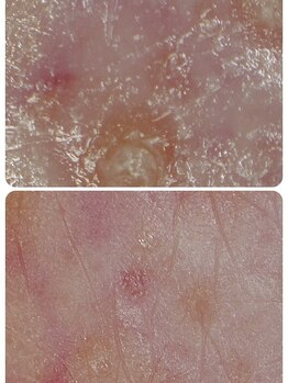 ゼロプラス(ZERO+)/【フェイシャル】効果実感!