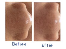 リッシュ(Riche)/毛穴ケア