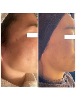 美バストアルファ(美bust α)/【シミ改善】