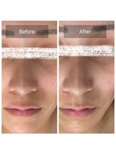 ラビ(RABBI)/20代女性毛穴洗浄