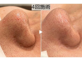 ロワ(Roi)/【毛穴洗浄+顔脱毛】4回施術