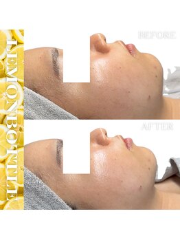 リアム(LiAm)/脂肪分解剤《レモンボトル》