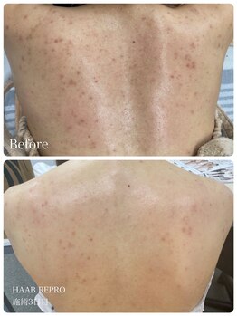 アルマサロン 菊陽(Almasalon)/【HAAB REPRO】ハーブリプロ