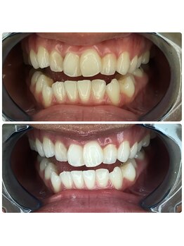 グリッター ショウナン(glitter. SHONAN)/藤沢ホワイトニングbefore/after