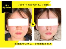 イエス マイサロン(yes My Salon)/レモンボトル施術例