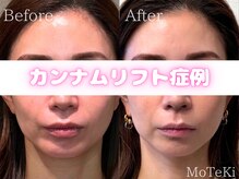 モテキ 表参道店(MoTeKi)