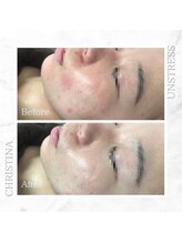 シャルムパリス(charme paris)/敏感肌の方も◎１回の施術変化