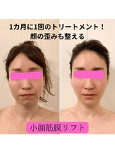 ソエルテ(soerute)/小顔筋膜リフトで歪み解消！